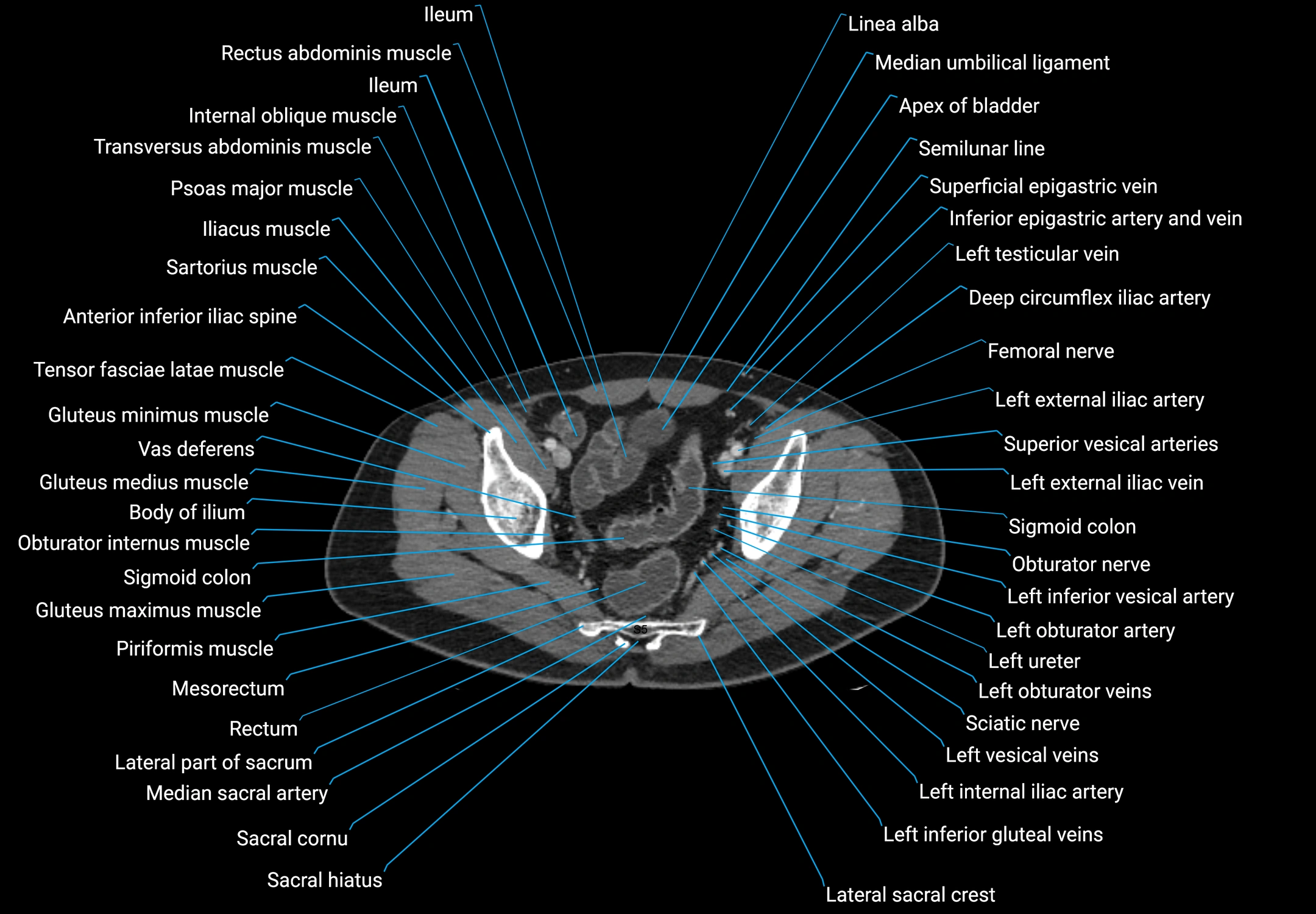 CT male pelvis axial cross sectional anatomy labelled radiology image -00172.webp